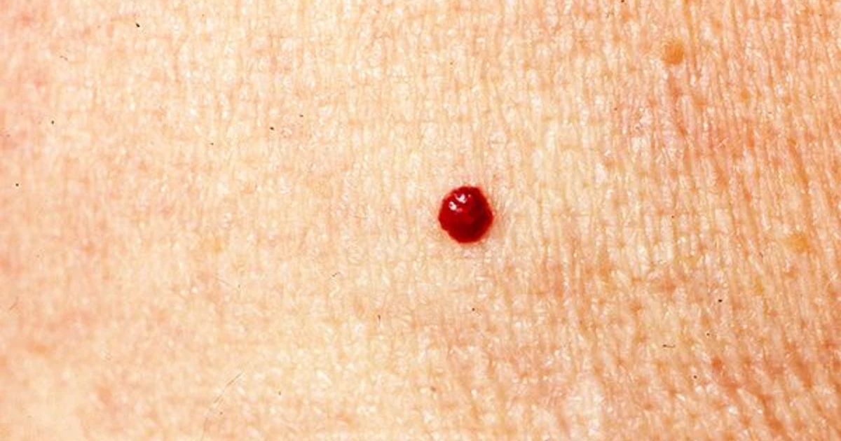 How to Stop Your Cut-off Skin Tags from Bleeding?