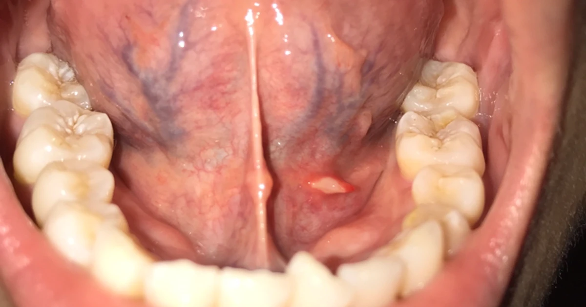 Do You have a Skin Tag Under Your Tongue, Plica Fimbriata?