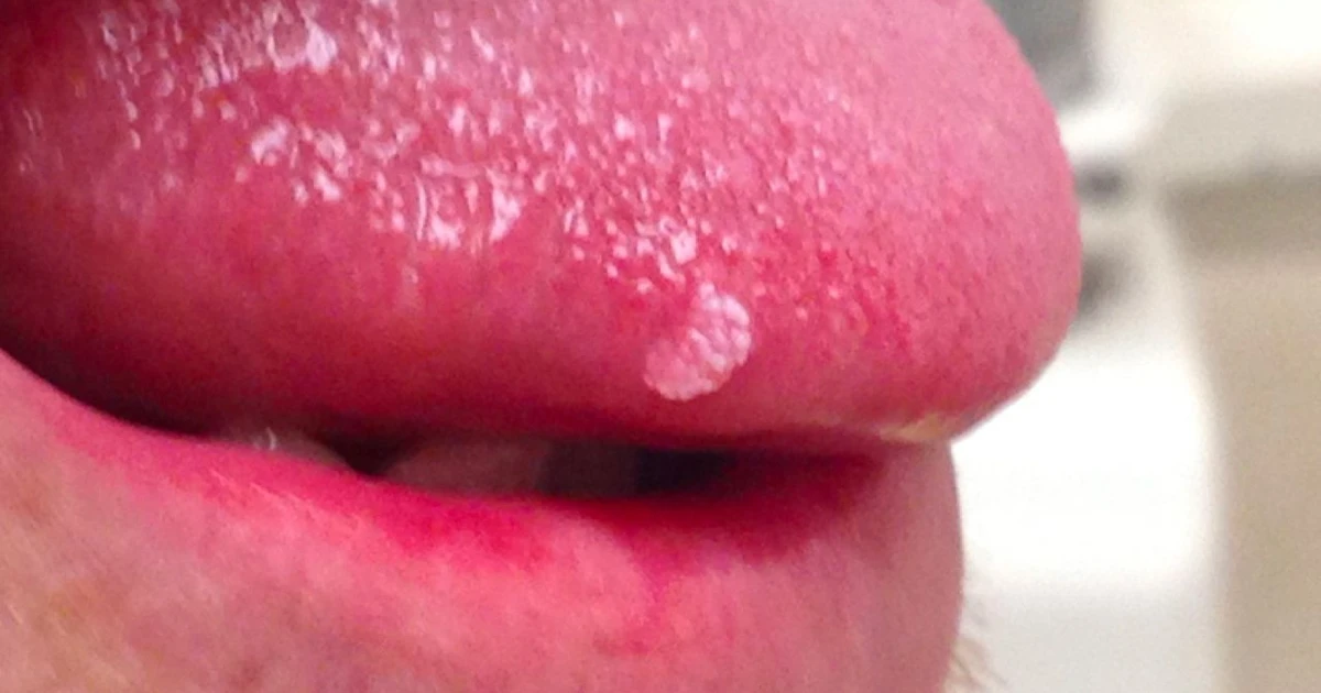 Tongue Skin Tag What Is It And How To Remove It?